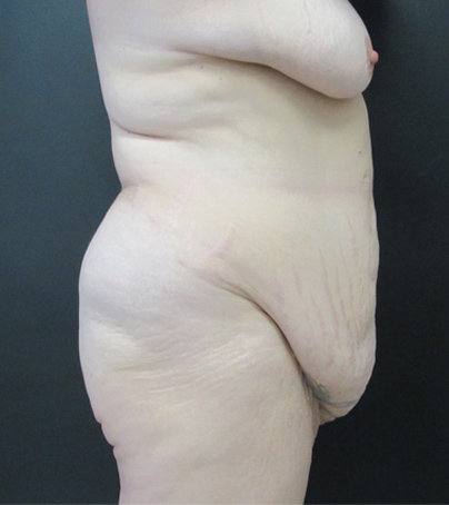 Tummy Tuck case #5510