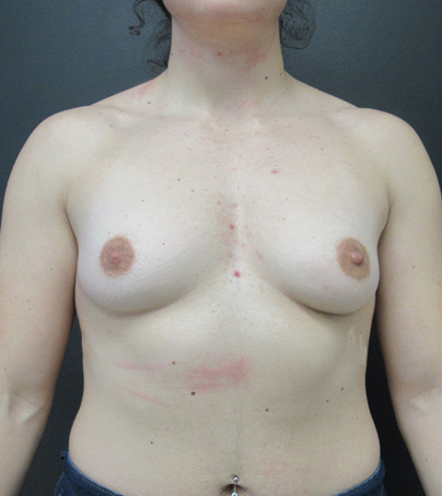 Breast Augmentation case #5548