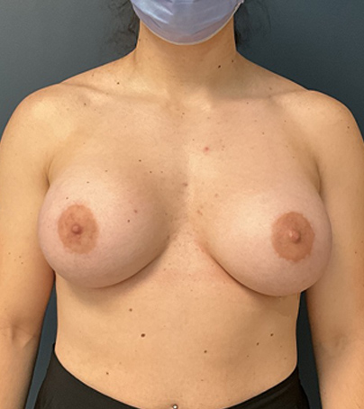 Breast Augmentation case #5548