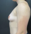 Breast Augmentation case #5548