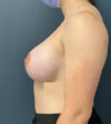 Breast Augmentation case #5548