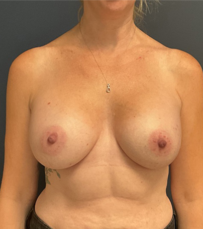 Breast Augmentation case #5562