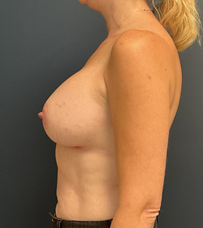 Breast Augmentation case #5562