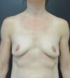 Breast Augmentation case #5571