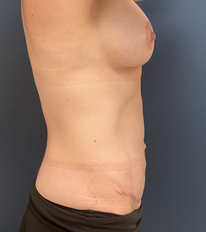 Tummy Tuck case #5579