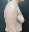 Breast Augmentation case #5596