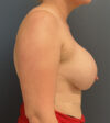 Breast Augmentation case #5596