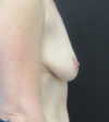 Breast Augmentation With Lift case #5651