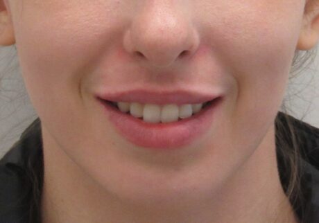 Dermal Fillers case #5995