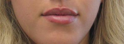 Dermal Fillers case #6333