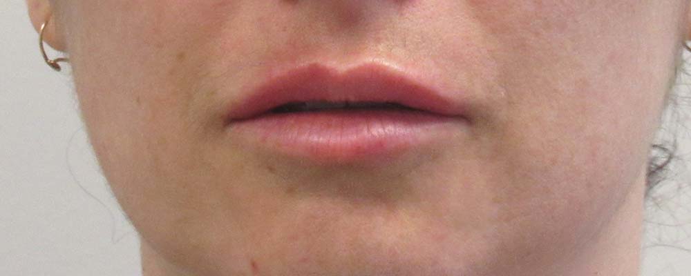 Dermal Fillers case #6329