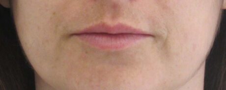 Dermal Fillers case #6329