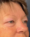 Eyelid Surgery case #7096