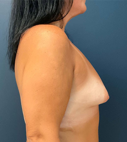 Breast Augmentation case #7173