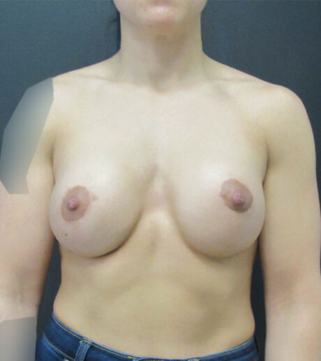 Breast Augmentation case #7446