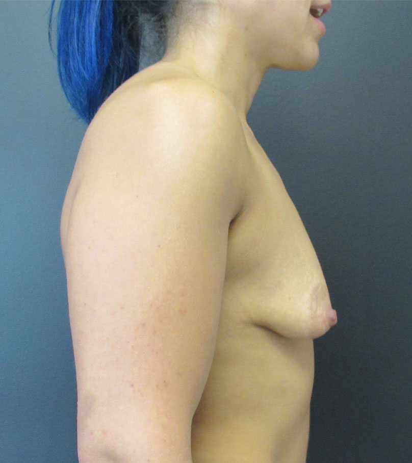 Breast Augmentation case #7446