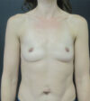 Breast Augmentation case #7473