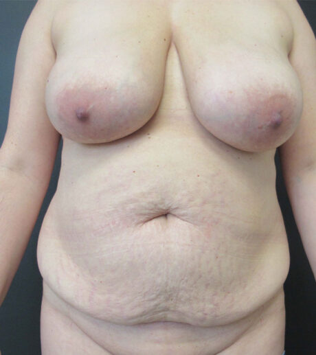 Breast Lift case #7505