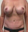 Breast Lift case #7505