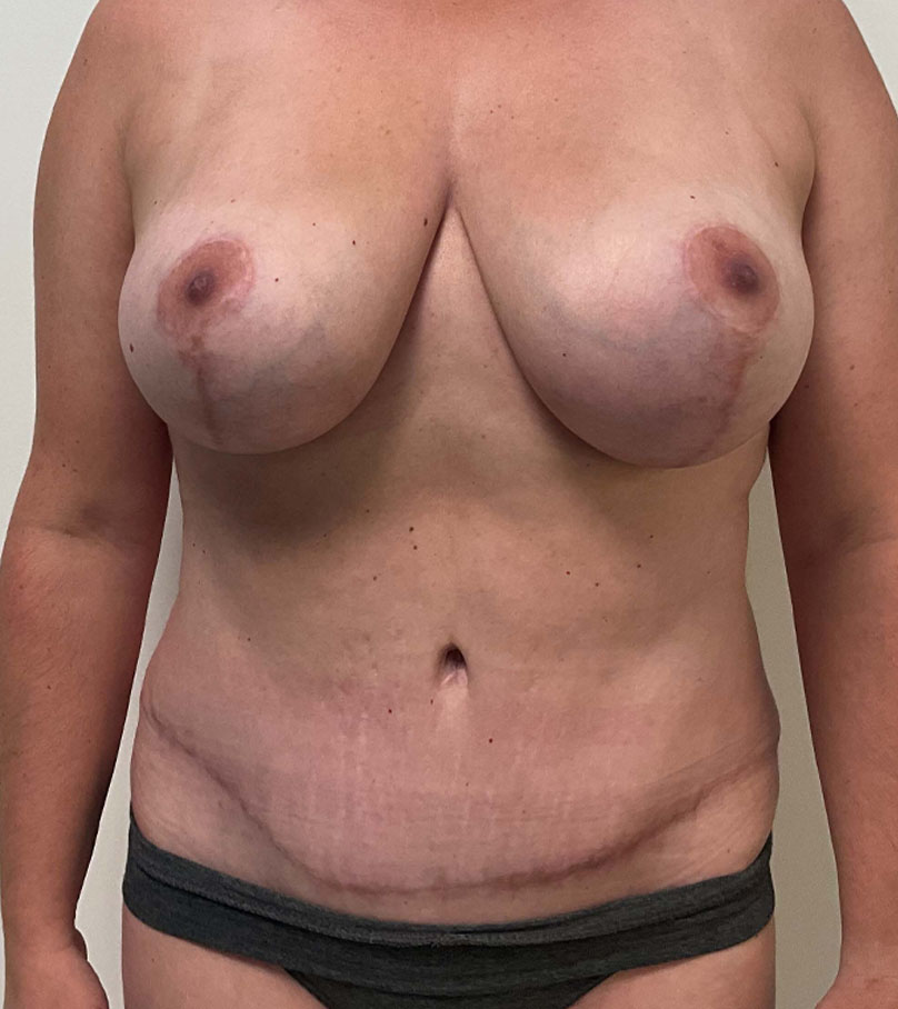 Breast Lift case #7505