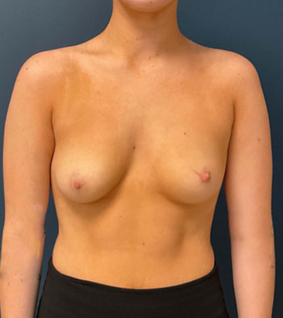 Breast Augmentation case #7220