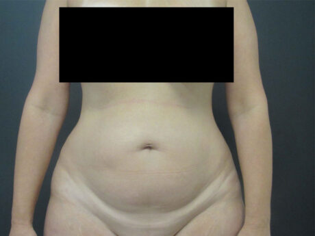 Tummy Tuck case #7190