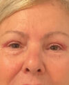 Eyelid Surgery case #7131