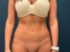 Tummy Tuck case #7190