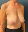 Breast Lift case #7276
