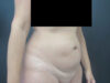 Tummy Tuck case #7190