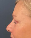 Eyelid Surgery case #7131