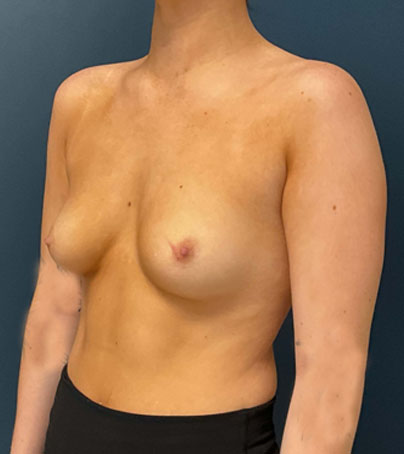 Breast Augmentation case #7220