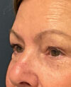 Eyelid Surgery case #7131