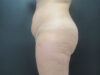 Tummy Tuck case #7190