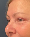 Eyelid Surgery case #7131
