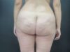 Tummy Tuck case #7190