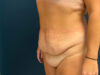 Tummy Tuck case #7178