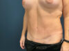 Tummy Tuck case #7178