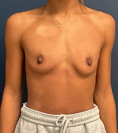 Breast Augmentation case #7219