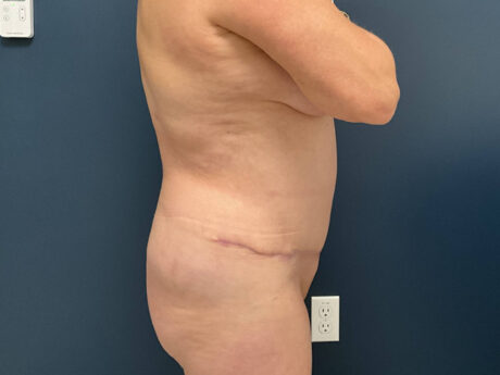 Tummy Tuck case #7185