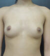Breast Augmentation case #7263