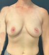 Breast Augmentation case #7247