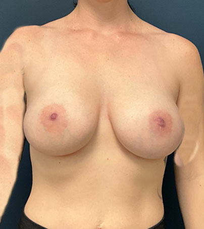 Breast Augmentation case #7247