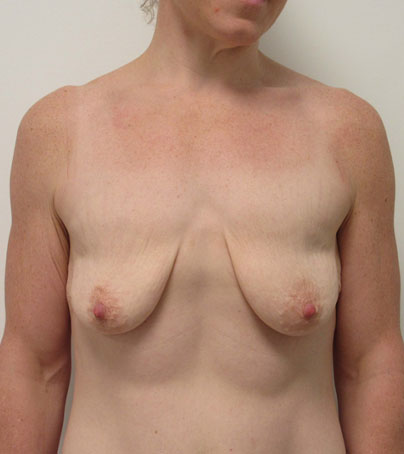 Breast Augmentation With Lift case #7274