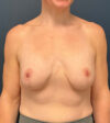 Breast Augmentation With Lift case #7274