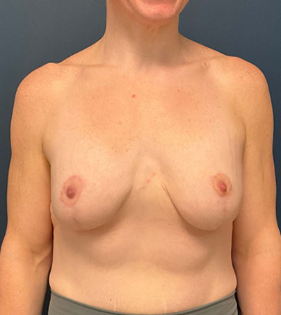 Breast Augmentation With Lift case #7274