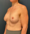 Breast Augmentation With Lift case #7274