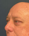 Eyelid Surgery case #7139