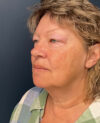 Facelift case #7105