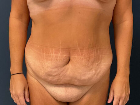 Tummy Tuck case #7178